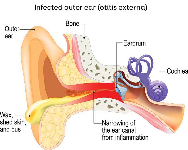 Infected Outer Ear