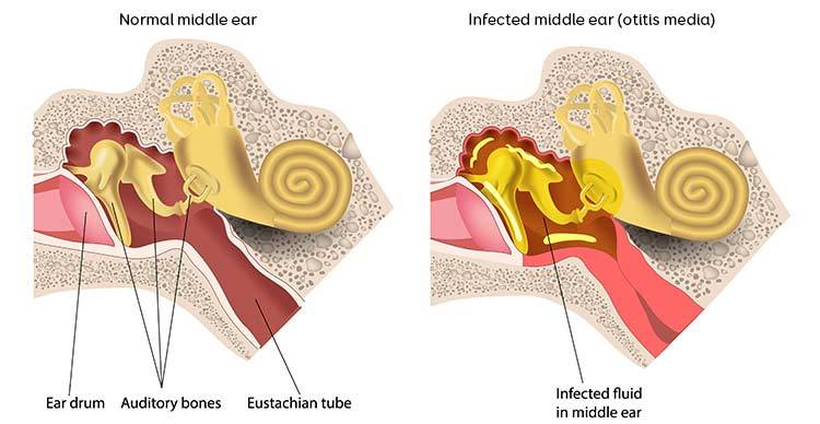 Middle Ear Infection