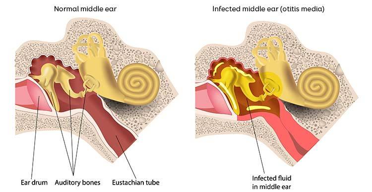 Ear Pain: Causes And Treatment Options